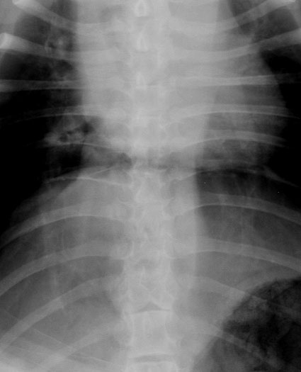 Spine hemivertebra (thoracic) - radiograph VD