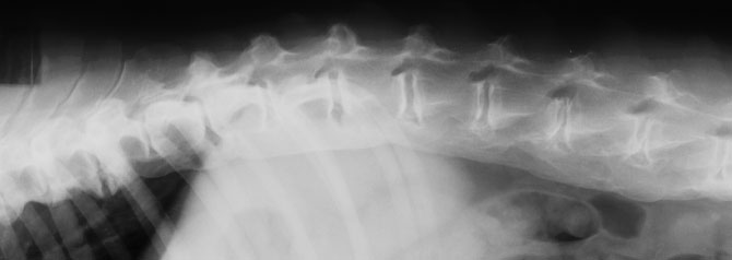 Spine severe spondylosis (thoracolumbar) - radiograph lateral
