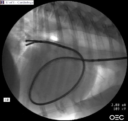 Caval syndrome: heartworm extraction
