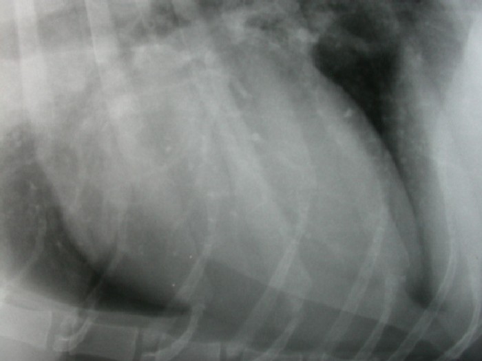 Lung: pleural plaques (close up) radiograph lateral