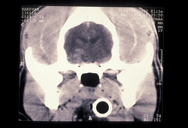 Brain biopsy 01: intraparenchymal hemorrhage CT