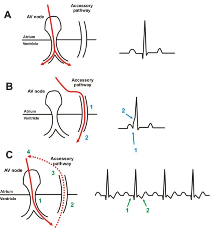 Heart: WPW - anatomic arrangement and electrical pathway