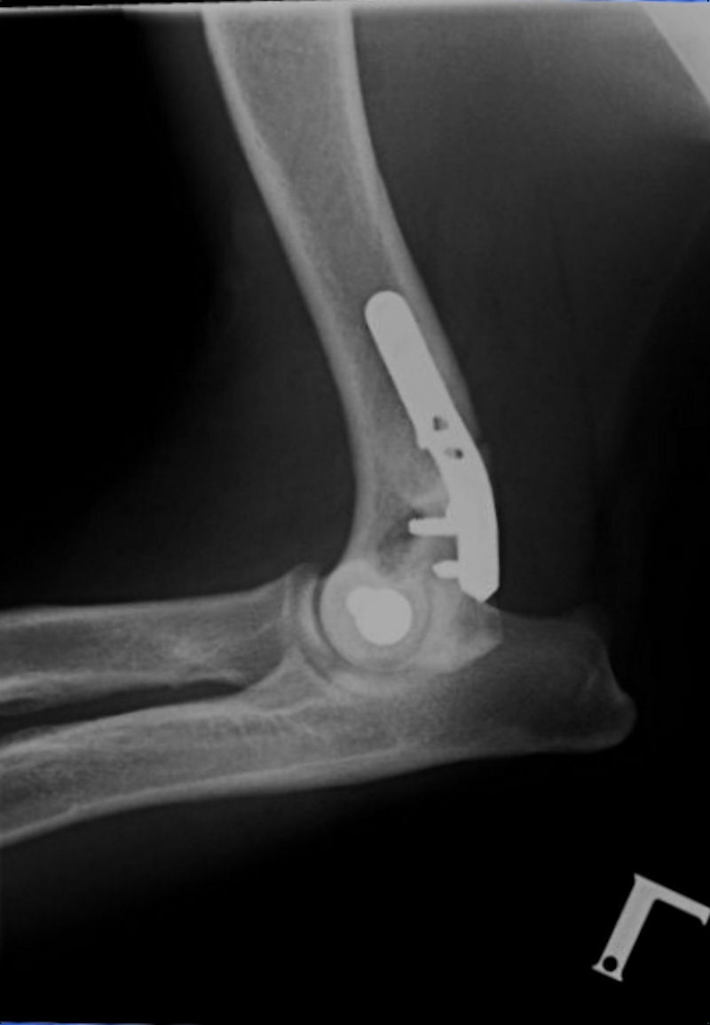 Elbow: lateral humeral condylar fracture (postoperative) 02 - radiograph mediolateral