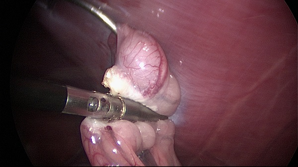 Laparoscopy: ovariectomy 01 - dissect ligament