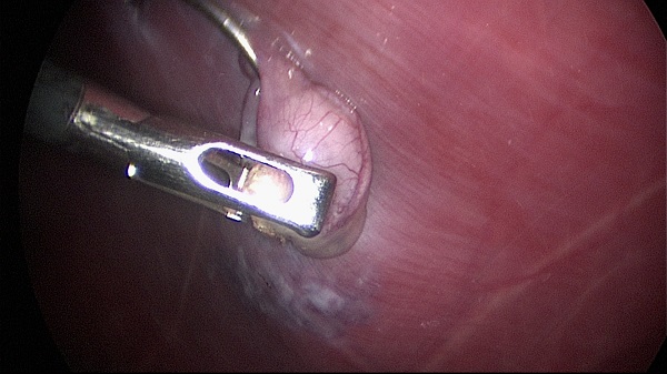 Laparoscopy: ovariectomy 02 - grasp dissected ovary