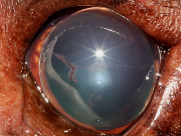 Eye: anterior lens luxation - Labrador Retriever