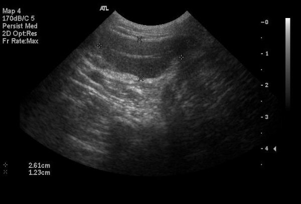 Testis: cryptorchid (abdominal) - ultrasound