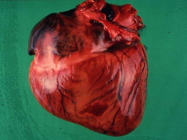 Myocardial infarct pathology