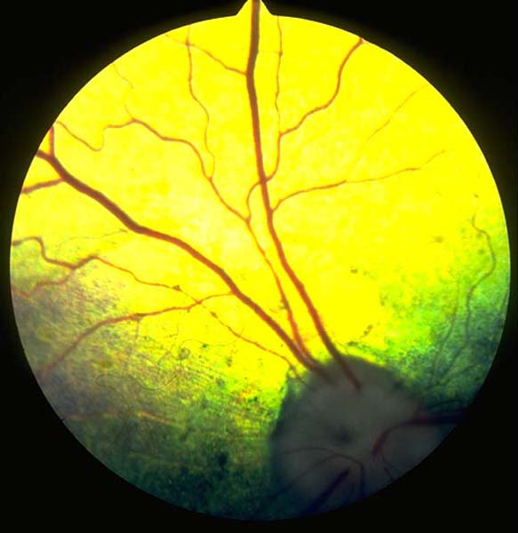 Post-inflammatory retinopathy 02 Labrador 8 years
