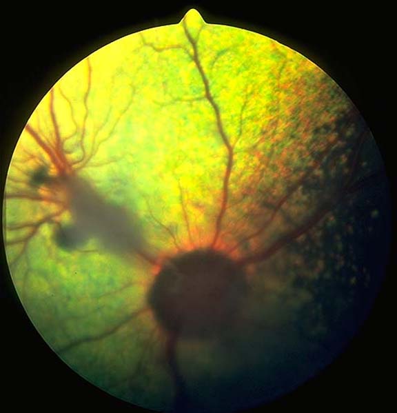Post-inflammatory retinopathy 08 English Springer Spaniel 3 years