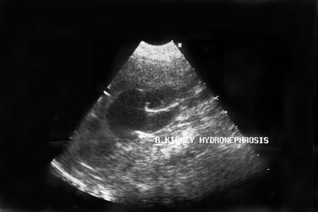 Kidney hydronephrosis (severe) - ultrasound