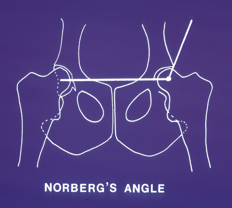 Pelvis Norbergs angle - diagrammatic representation