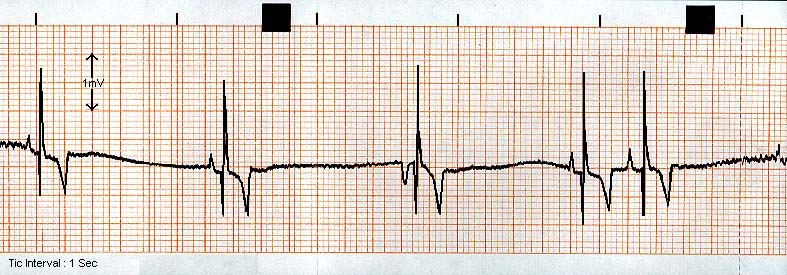 ECG sinus bradycardia
