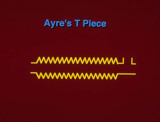 Anesthetic circuit T-piece