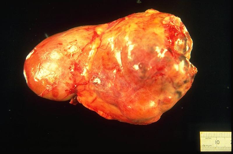 Kidney renal carcinoma 01 - pathology