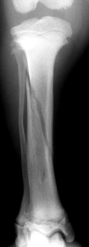 Tibia spiral fracture - radiograph CrCd