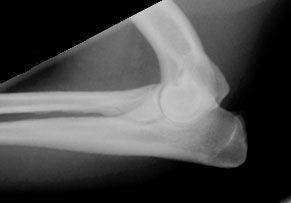 Elbow normal 01 - radiograph lateral