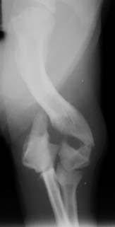 Elbow Y-fracture - radiograph