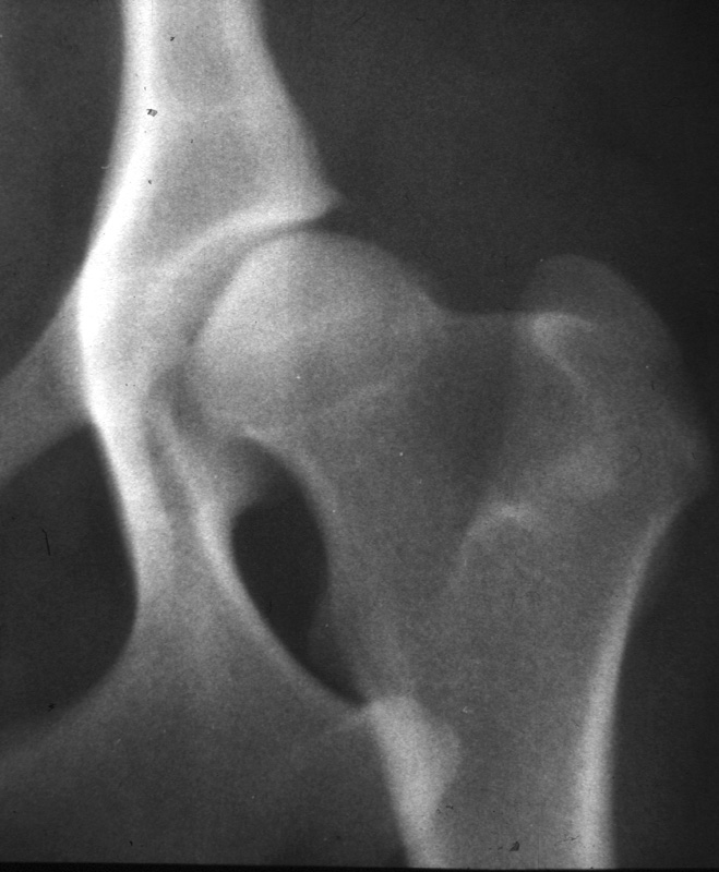 Hip moderate dysplasia - radiograph