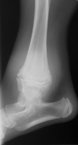 Bone metaphyseal osteopathy (early) - radiograph