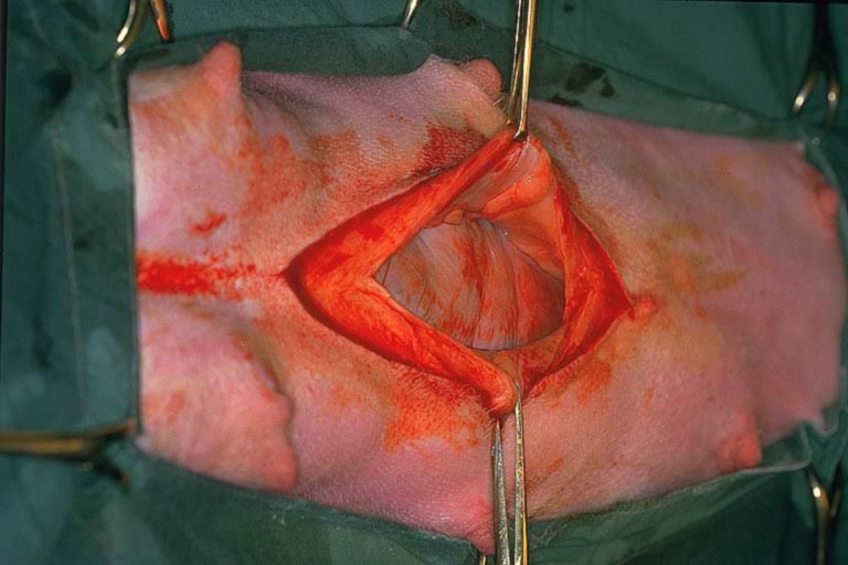 Cesarean 03 laparotomy incision