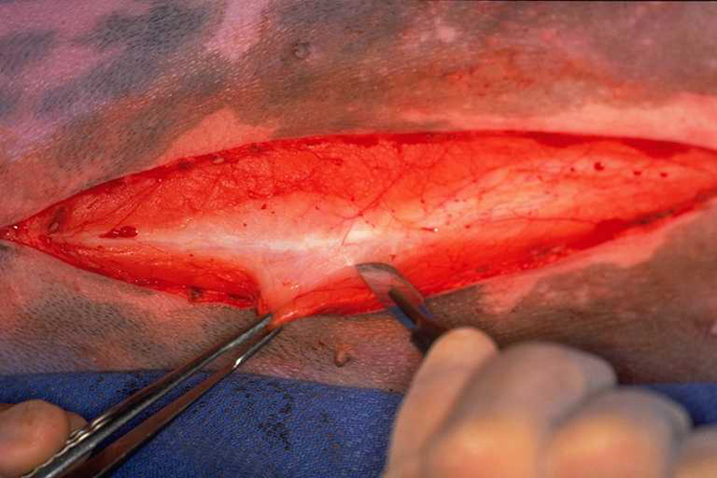 Laparotomy 06 dissect subcutaneous tissue