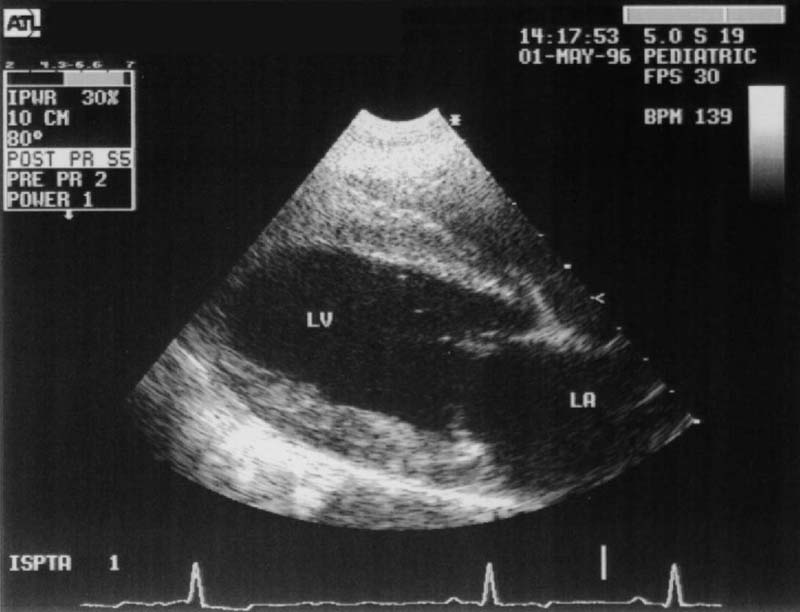 Heart normal right side long axis for left atrium - ultrasound