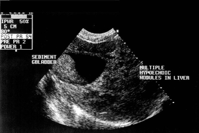 Liver: gall bladder sediment 01- ultrasound