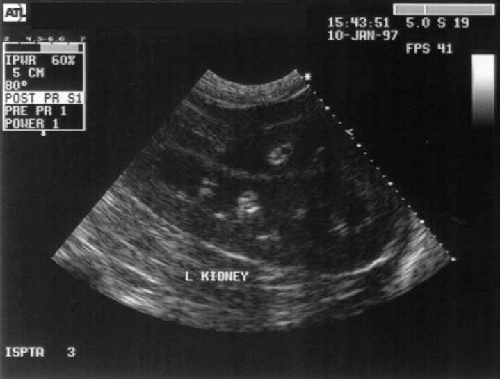 Kidney normal long-axis - ultrasound