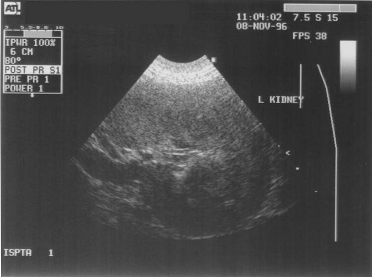 Kidney chronic renal disease - ultrasound