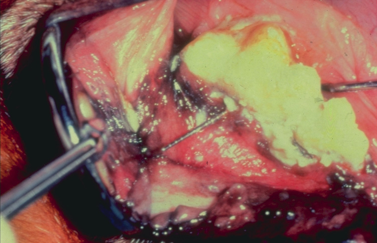 Teeth graduated periodontal probe in exposed funcation