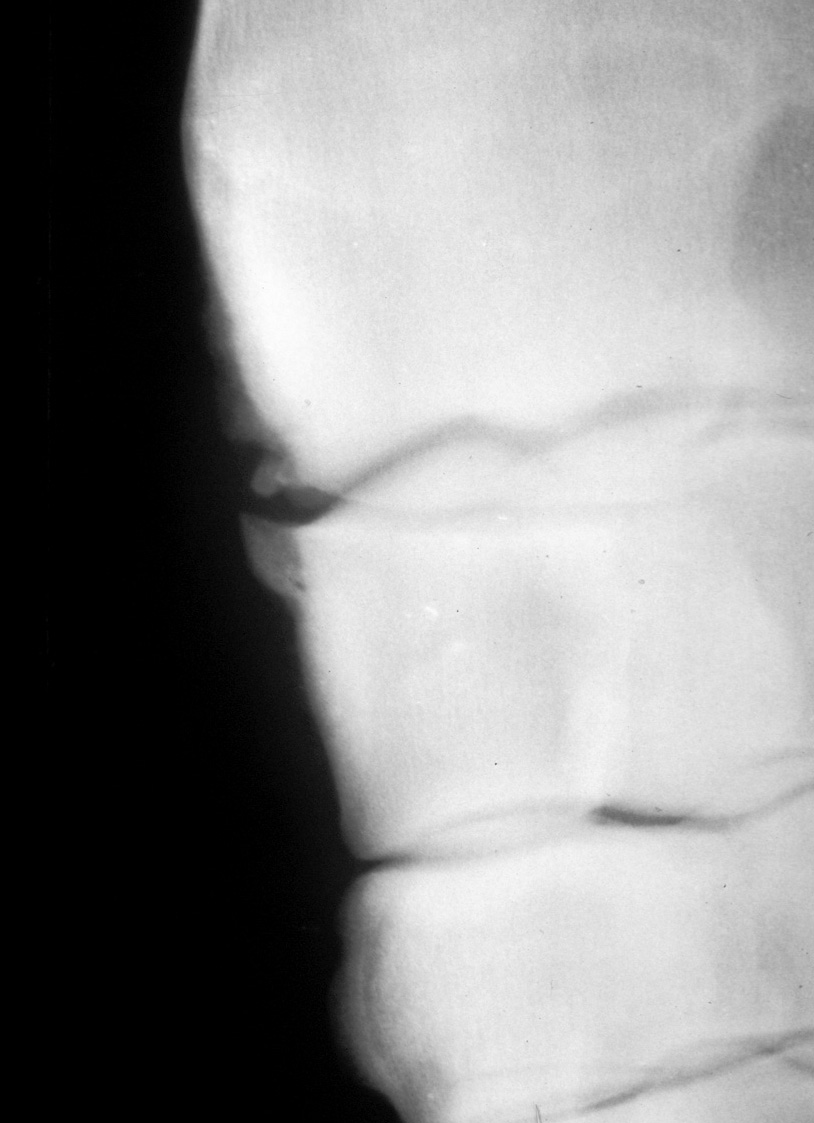Radiocarpal joint: osteoarthritis 01 - radiograph