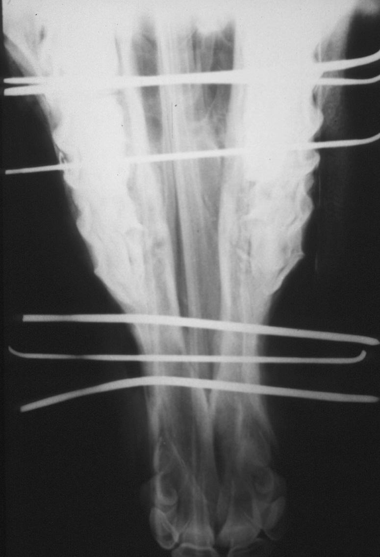 Mandible: fracture 03 - repair - VD radiograph