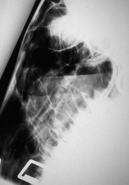 Paranasal sinus: sinusitis 04 - LM radiograph