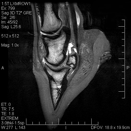 Foot: sagittal T2-weighted image 01 - MRI