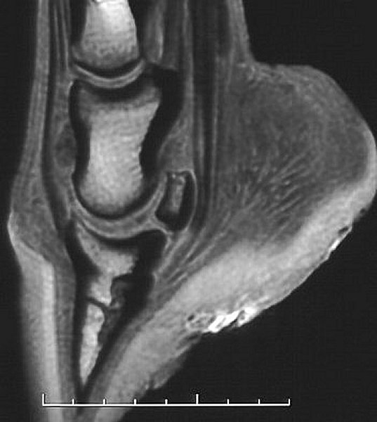 Foot: sagittal T1-weighted image - MRI