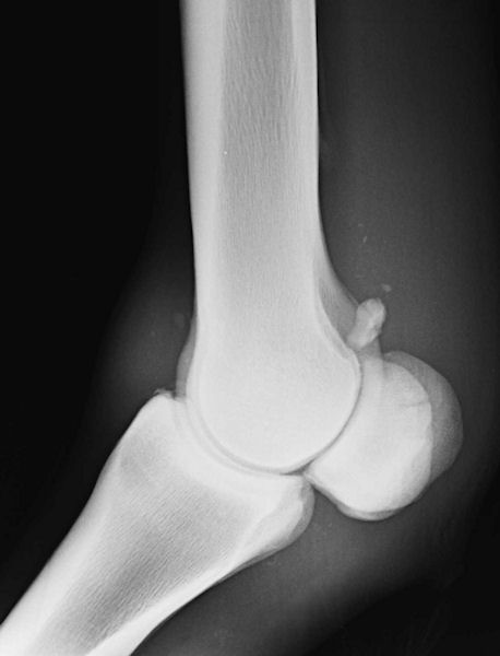 Proximal sesamoid: fracture 17 comminuted - LM radiograph