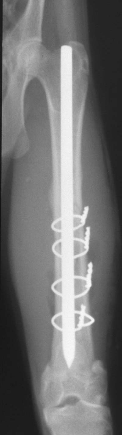 Femur: fracture repair 01 (IM pin with cerclage wire) - radiograph CrCd