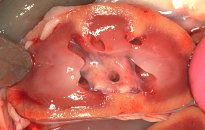 Kidney: hydronephrosis - pathology