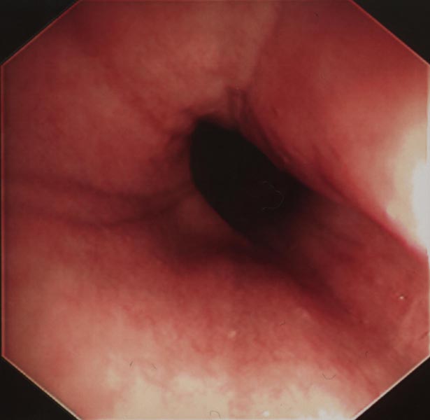 Esophagus: normal proximal - esophagoscopy