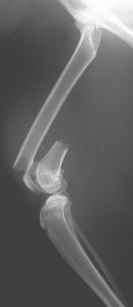 Femur: distal fracture - radiograph lateral