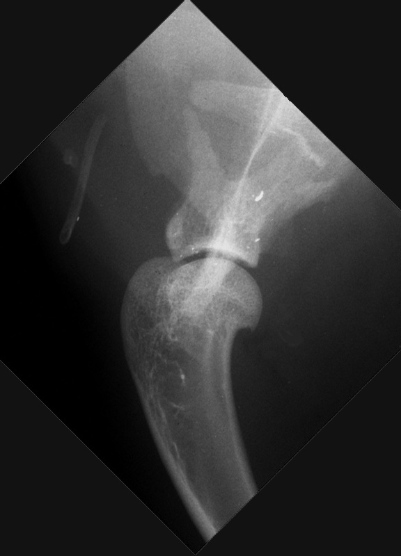 Scapula: fracture (due to gunshot) - radiograph lateral