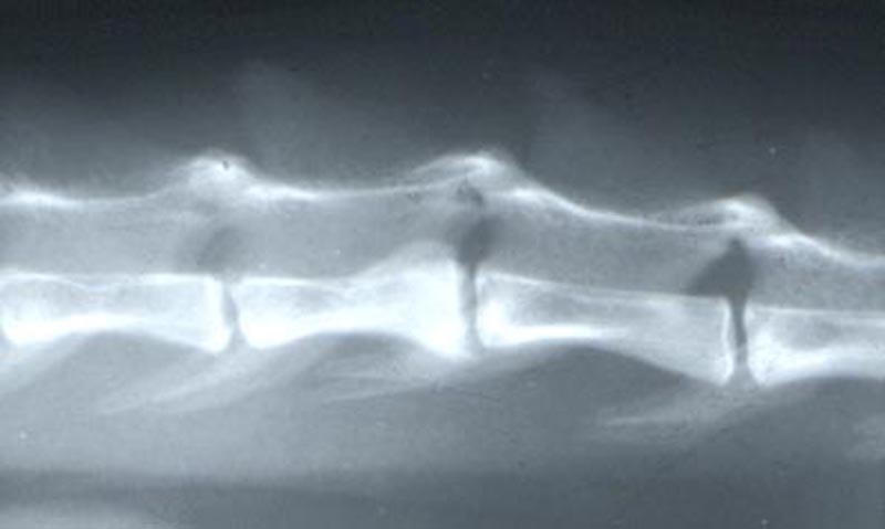 Vertebra: lumbar compression fracture 02 - radiograph lateral