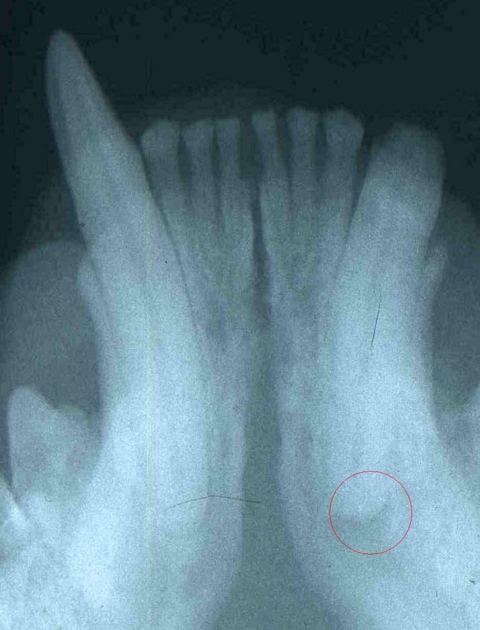 Teeth: crown fractures 02 - radiograph