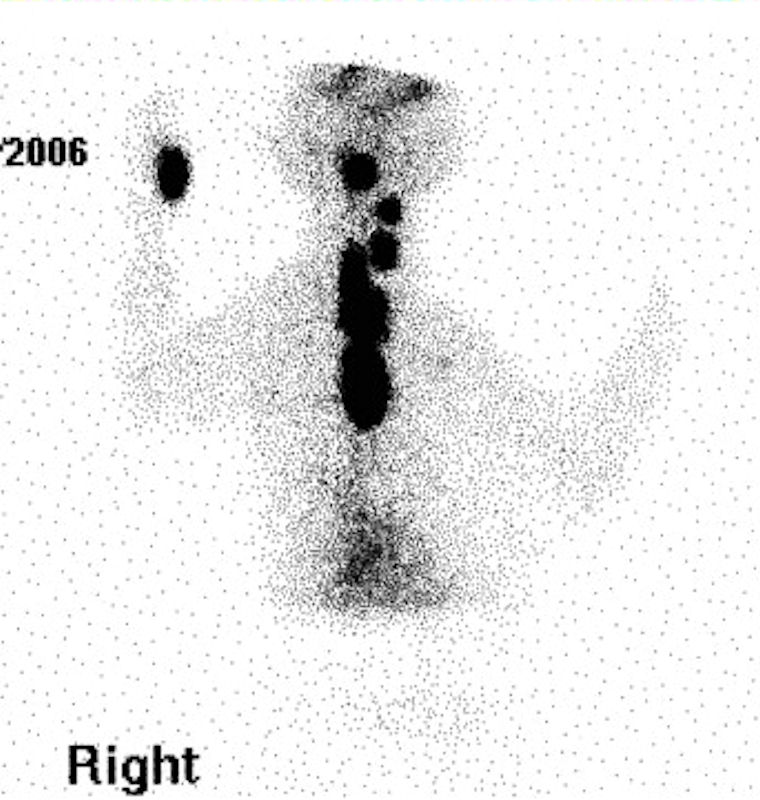Thyroid gland: neoplasia 01 - scintigram