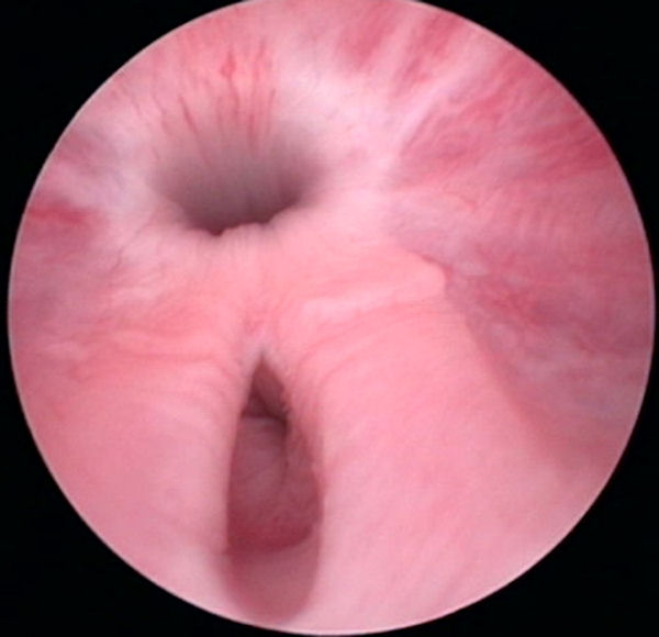 Vagina: normal vestibule - cystoscopy