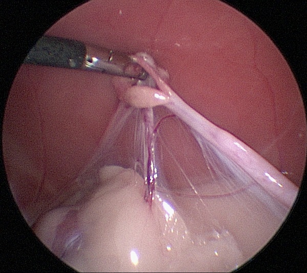 Laparoscopy: ovariectomy - suspend ovary