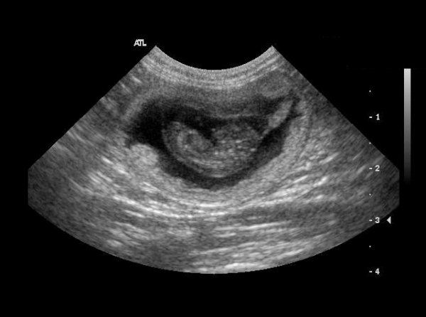 Abdomen: pregnancy 30 days gestation 02 - ultrasound