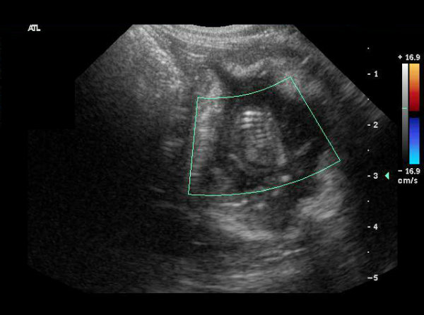 Abdomen: fetal death - ultrasound