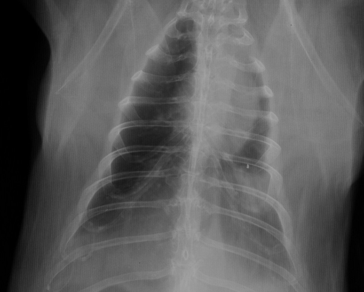 Lung: pneumonia DV radiograph